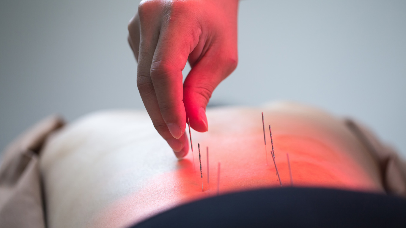 experience-acupuncture